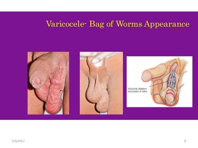 varicocèle photo varicocèle photo